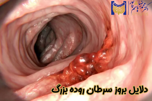  دلایل بروز سرطان روده بزرگ