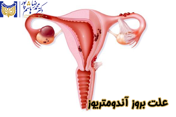 دلایل بروز آندومتریوز