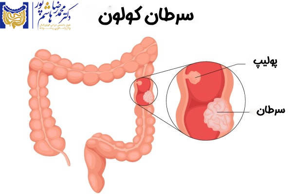 مرحله اولیه سرطان