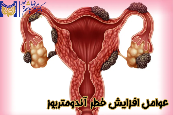 عوامل افزایش خطر آندومتریوز