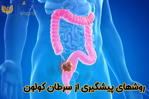 روشهای پیشگیری از سرطان کولون