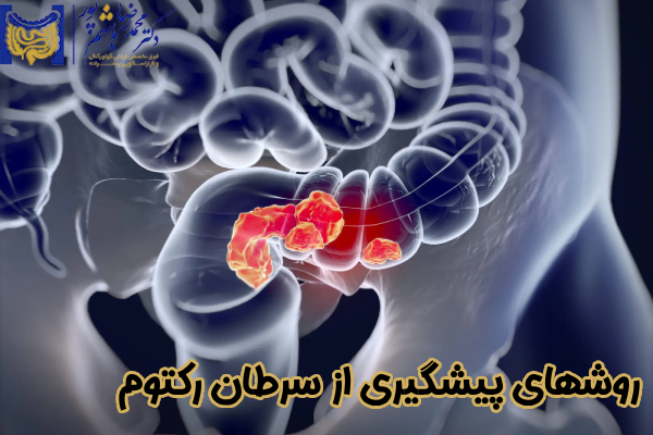 روشهای پیشگیری از سرطان رکتوم