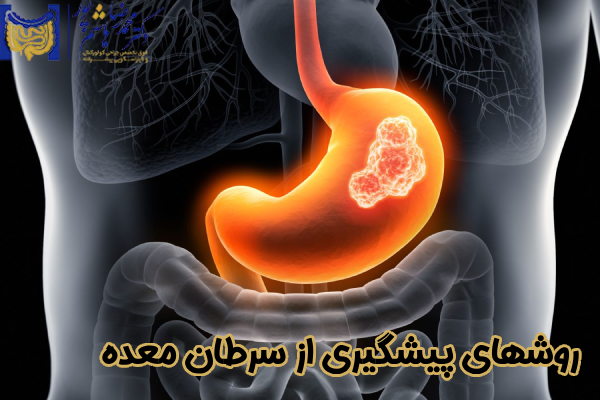 روشهای پیشگیری از سرطان معده
