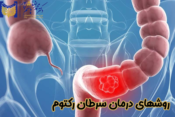 روشهای درمان سرطان رکتوم