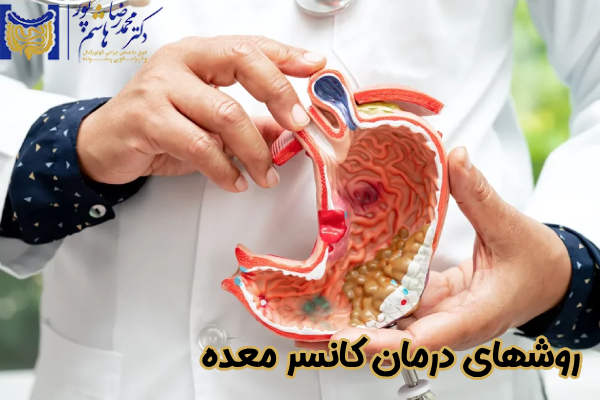 روشهای درمان کانسر معده