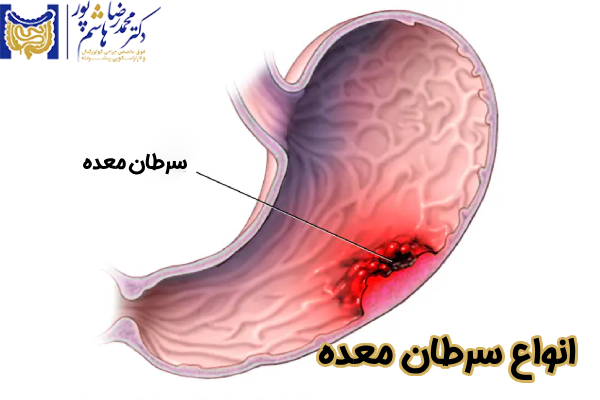 انواع سرطان معده