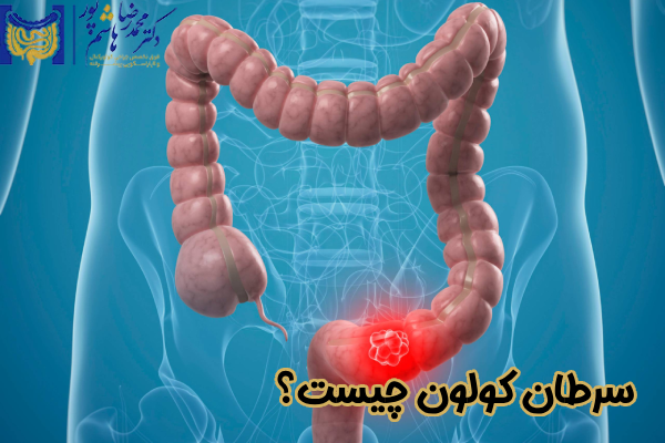 سرطان کولون چیست