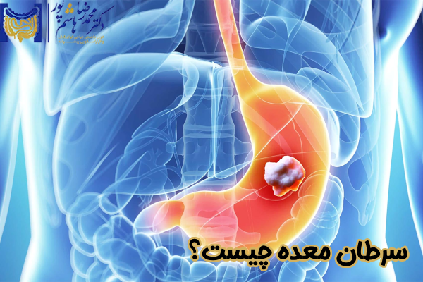سرطان معده چیست