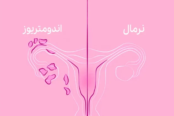 اندومتریوز چیست