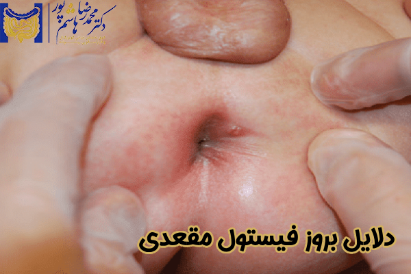 دلایل بروز فیستول مقعدی