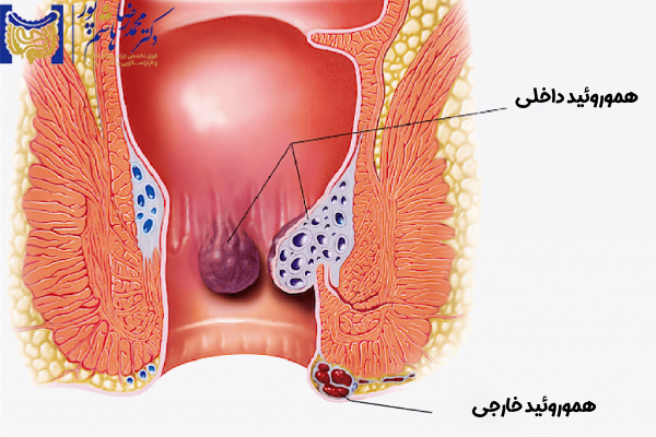 عوارض هموروئید