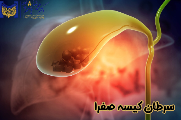 سرطان کیسه صفرا