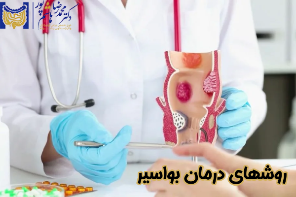 روشهای درمان بواسیر