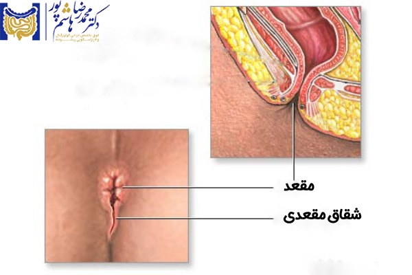 پیشگیری از بیماری شقاق مقعدی