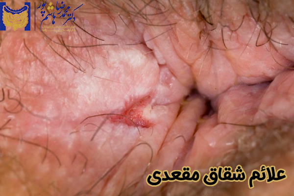 علائم شقاق مقعدی