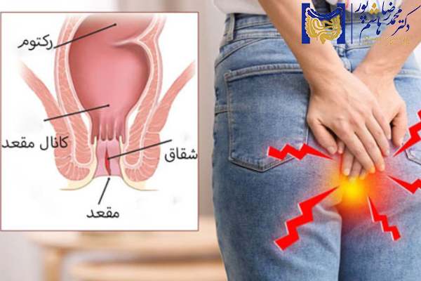 انواع شقاق مقعدی