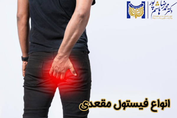 انواع فیستول مقعدی