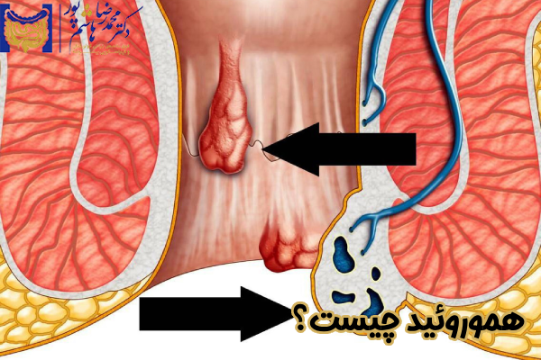 بواسیر چیست