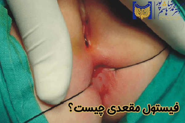 فیستول مقعدی چیست