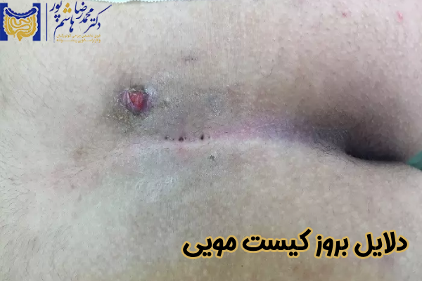 دلایل بروز کیست مویی