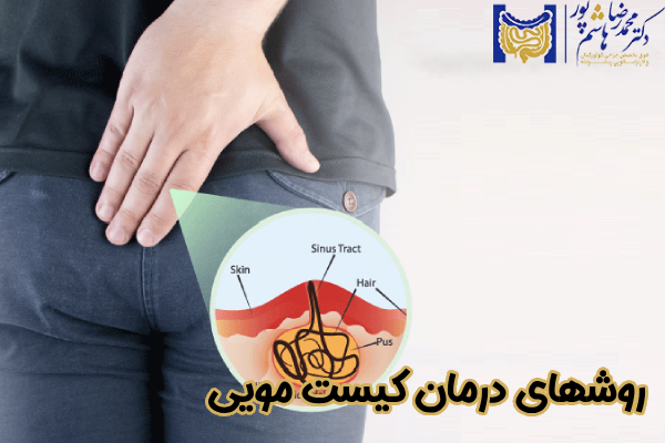 روشهای درمان کیست مویی