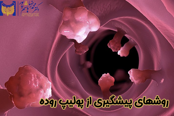 روشهای پیشگیری از پولیپ روده