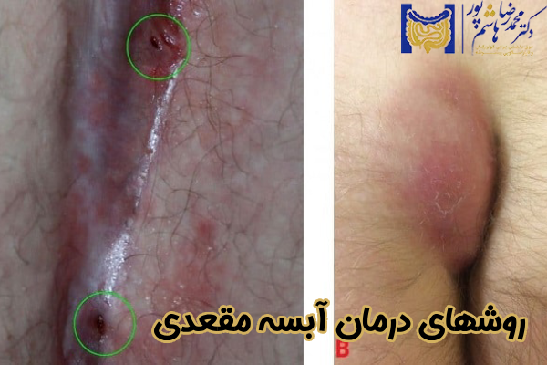 روشهای درمان آبسه مقعدی