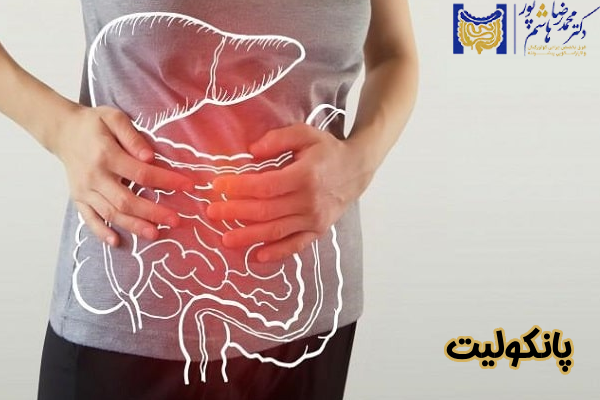 پانکولیت