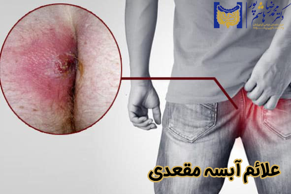 علائم آبسه مقعدی