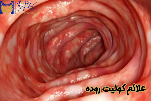 علائم کولیت روده