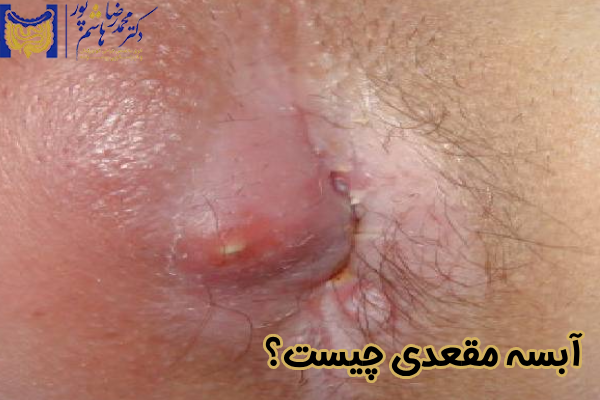 آبسه مقعدی چیست