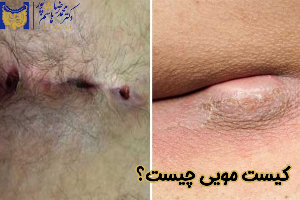 کیست مویی چیست