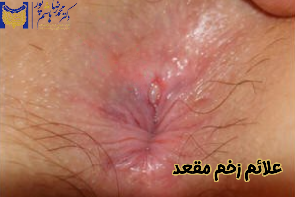 علائم زخم مقعد