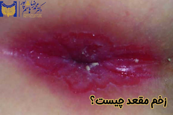 زخم مقعد چیست