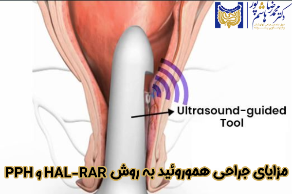 مزایای جراحی هموروئید به روش PPH و HAL-RAR