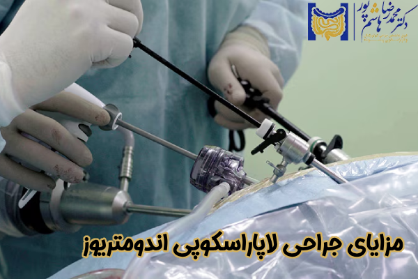 مزایای لاپاراسکوپی اندومتریوز