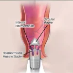 جراحی هموروئید از طریق (PPH) و (HAL-RAR)