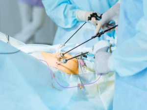 لاپاراسکوپی اندومتریوز