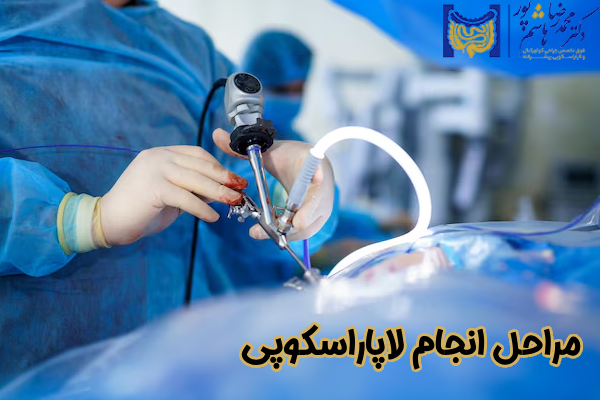 مراحل انجام لاپاراسکوپی
