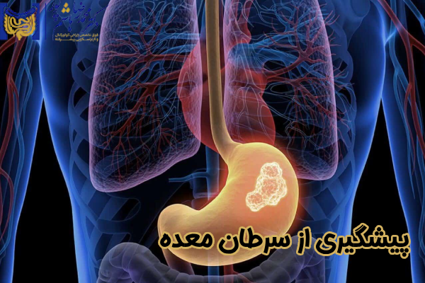 روشهای پیشگیری از سرطان معده