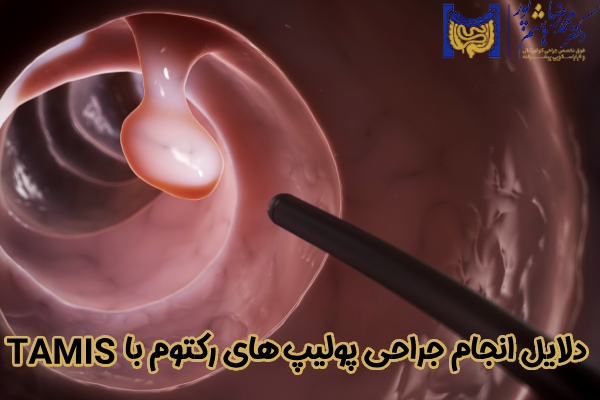 دلایل انجام جراحی پولیپ‌ های رکتوم با TAMIS