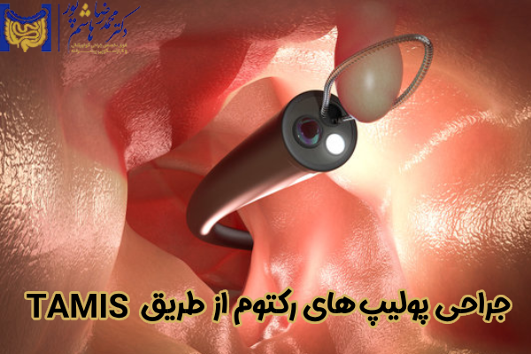 جراحی پولیپ رکتوم از طریق TAMIS چیست