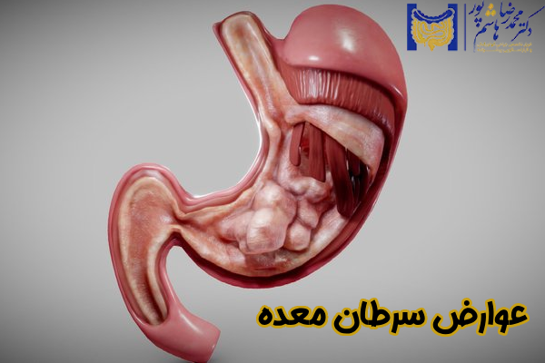 عوارض سرطان معده چیست