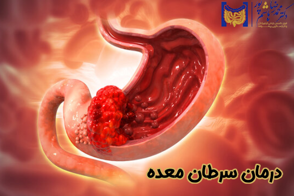 درمان سرطان معده چیست