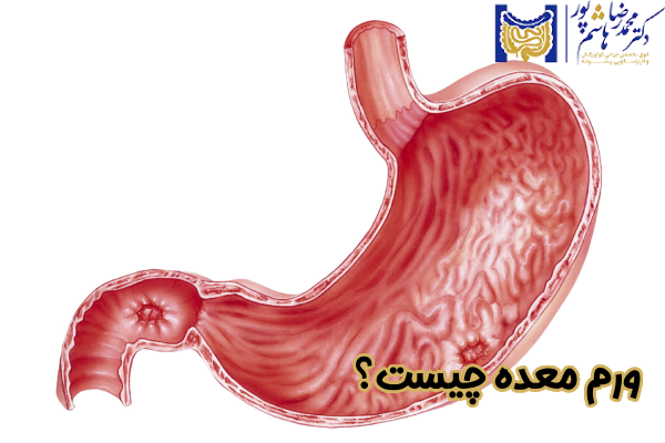 ورم معده چیست