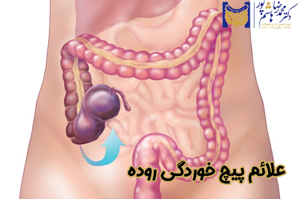 علائم پیچ خوردگی روده