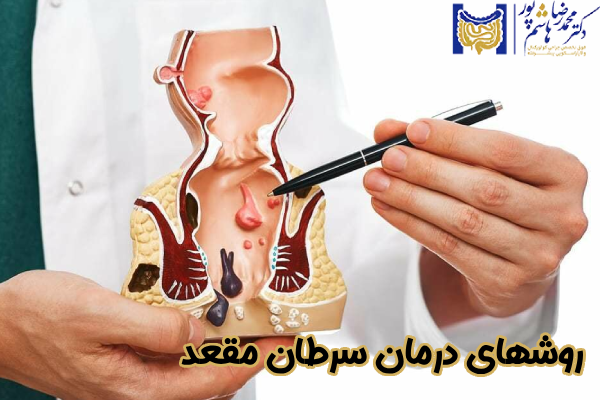 روشهای درمان سرطان مقعد