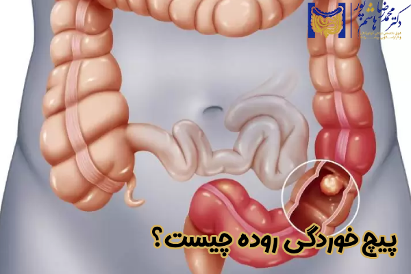 پیچ خوردگی روده چیست